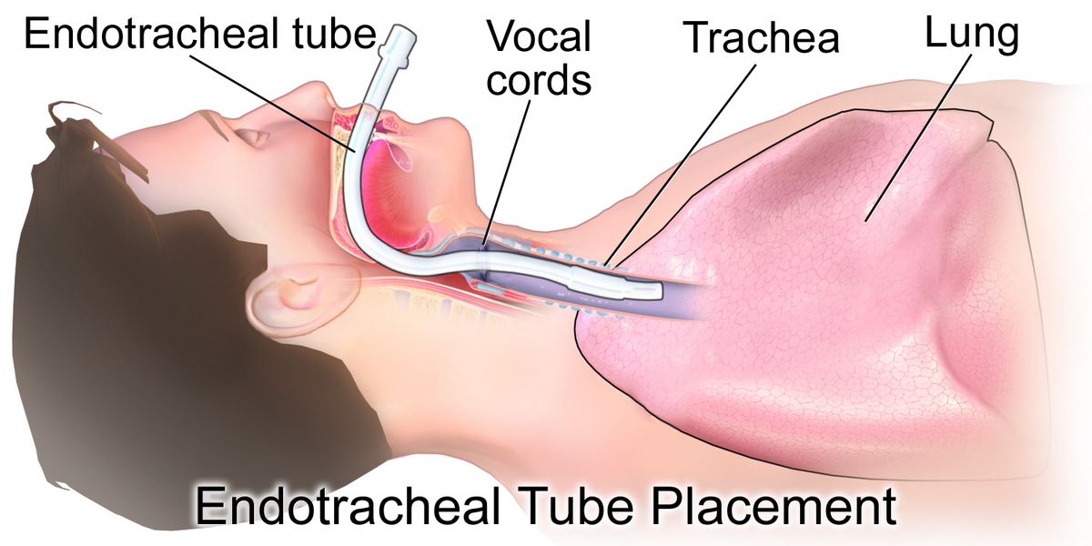 Proč se dělá intubace?