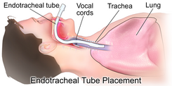 Image of endotracheal tube placement required to connect a patient's physiologic airway to the ventilator. Endotracheal Tube.png