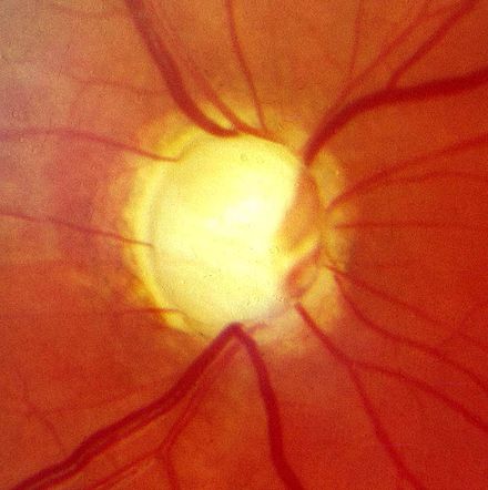 Optic nerve in advanced glaucoma disease
