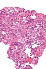 Micrograph showing lung transplant rejection. Lung biopsy. H&E stain. Lung transplant rejection - intermed mag.jpg