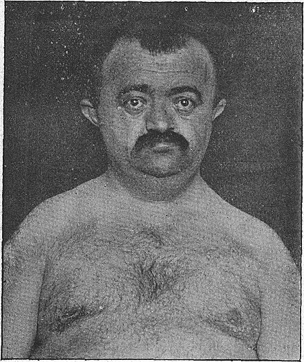 Adult male patient described by Marie and Sainton, 1898