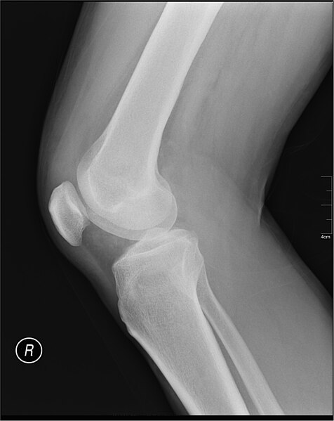 File:Medical X-Ray imaging CFA03 nevit.jpg