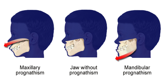 The Habsburg jaw can be attributed to inbreeding - https