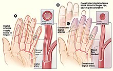 Raynaud syndrome - Wikipedia