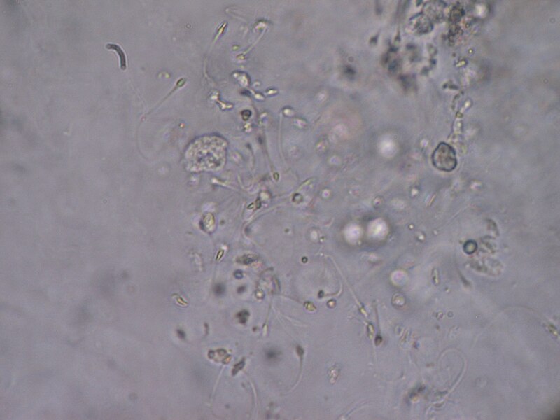 File:Sperm in urine.JPG