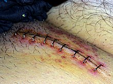 Surgical incision in groin after inguinal hernia operation Surgical staples3.jpg