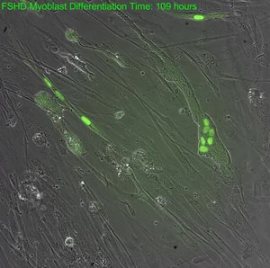 Datei: Zeitrafferexpression von DUX4-Protein in FSHD Cells.ogv