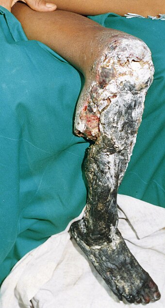 Severe tissue necrosis following Bothrops asper envenomation that required amputation above the knee. The person was an 11-year-old boy, bitten two weeks earlier in Ecuador, but treated only with antibiotics.[27]
