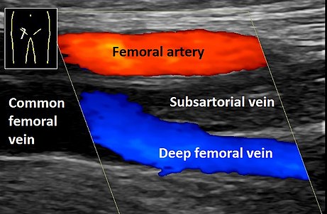 Ultrasonography of deep vein thrombosis of the femoral vein -annotated.jpg