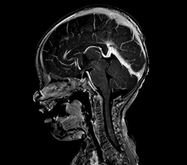 Vein of Galen thrombosis from ventricular puncture, not to be mistaken for an aneurysmal malformation