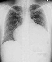 Abnormal chest X-ray as seen in a patient of atrial septal defect ASD Chest X-Ray.jpg