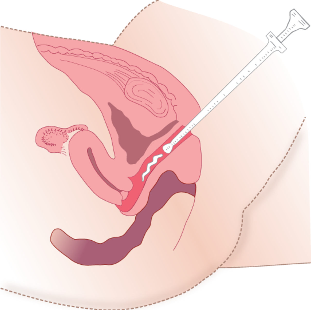 процедура введения спермы в матку фото 74