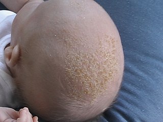 <span class="mw-page-title-main">Cradle cap</span> Human medical condition