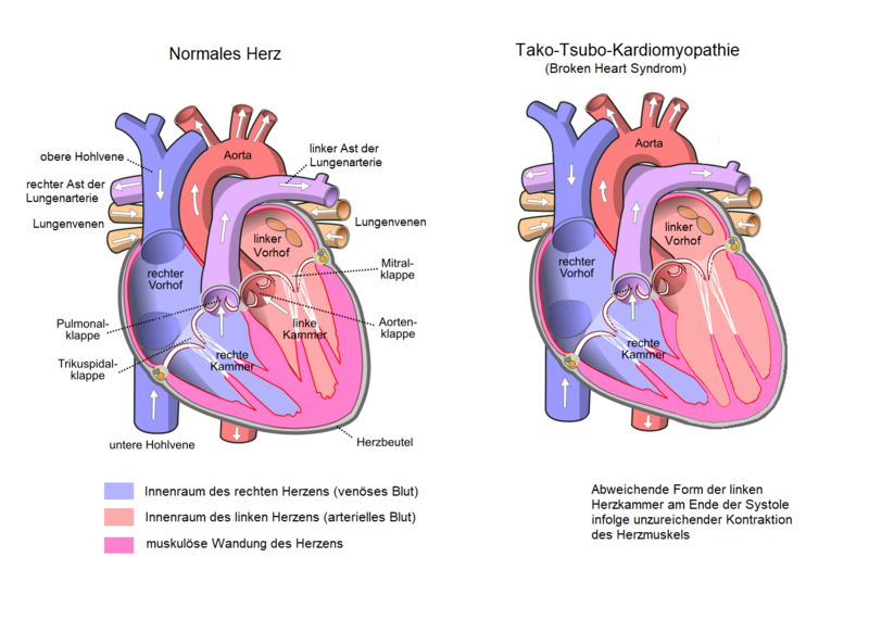 File:Broken Heart Syndrom.png