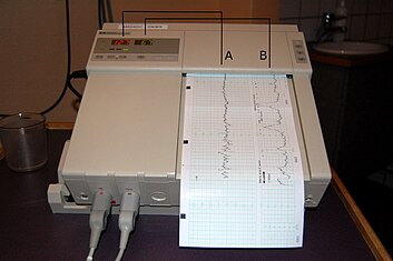 Cardiotocography is used to monitor fetal heart rate. Cardiotocography diagram.jpg
