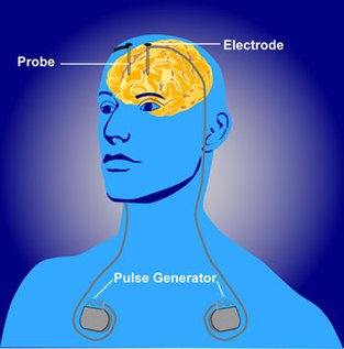 Illustration of deep brain stimulation Deep brain stimulation.jpg