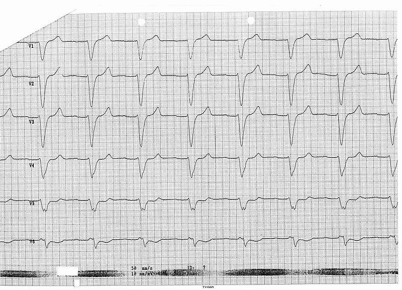 File:ECG 003 b.jpg