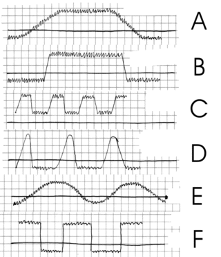 <span class="mw-page-title-main">Intermittent fever</span> Pattern of fever