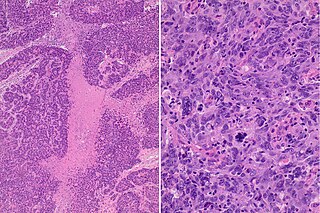 <span class="mw-page-title-main">Basal-like carcinoma</span> Breast cancer subtype