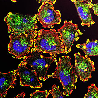 Metastatic melanoma cells Metastatic Melanoma Cells Nci-vol-9872-300.jpg