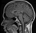 Thumbnail for Differential diagnoses of depression