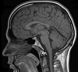 Neuroimaging can be a valuable tool in the diagnostic work-up of various psychiatric disorders including depression. Mrt big.jpg