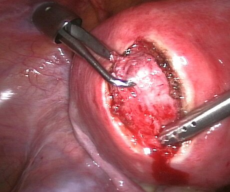 Uterine myomectomy