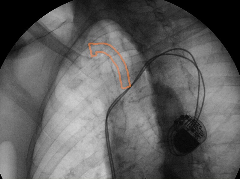 File:Tracheostoma mit einliegender Trachealkanuele Durchleuchtung 83W - RF schraeg - 001 - Annotation.jpg