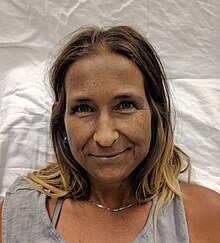 Hyperpigmentation as seen in a woman with Addison's disease WomenWithAddison.jpg