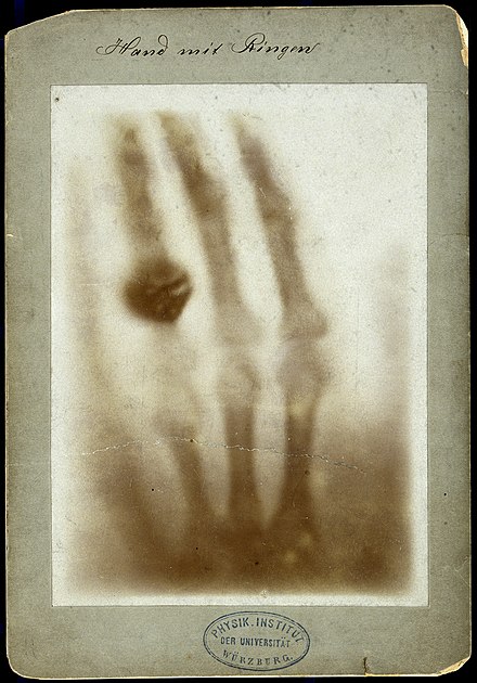 X-ray of the bones of a hand with a ring on one finger Wellcome V0029523.jpg