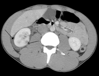 Abdominal trauma resulting in a right kidney contusion (open arrow) and blood surrounding the kidney (closed arrow) as seen on CTAbdominal trauma