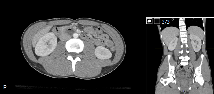 CT of a normal abdomen and pelvis, axial plane 131.png