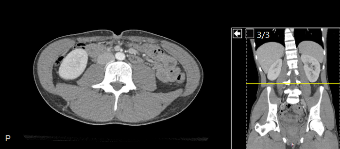 CT of a normal abdomen and pelvis, axial plane 146.png