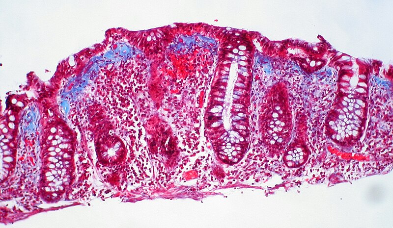 File:Collagenous colitis (4 of 4).jpg