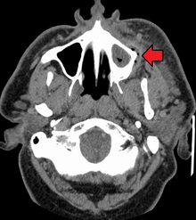 A dental infection resulting in an abscess and inflammation of the maxillary sinus Dental infectionMark.png