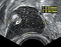 Dermoid cyst in vaginal ultrasonography
