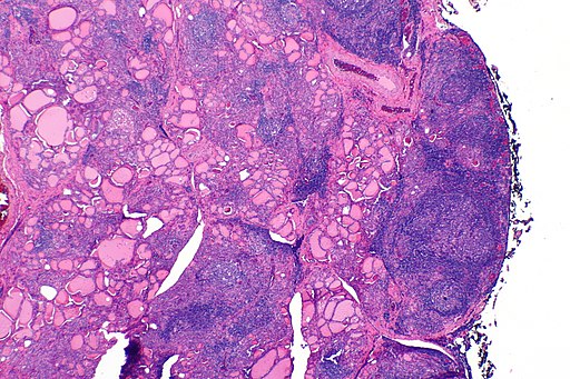 Hashimoto thyroiditis - alt -- very low mag