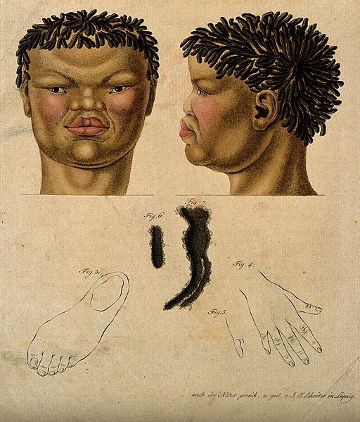 File:Head, neck, hand, foot and hair of a non-European woman. Col Wellcome V0008457.jpg