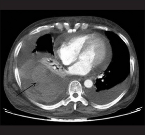 Hemothorax complicating rheumatoid arthritis