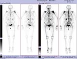 Scintigraphie corps entier avec 99mTc-HDP de la patiente avec une fracture du bras due à une métastase du cancer du sein