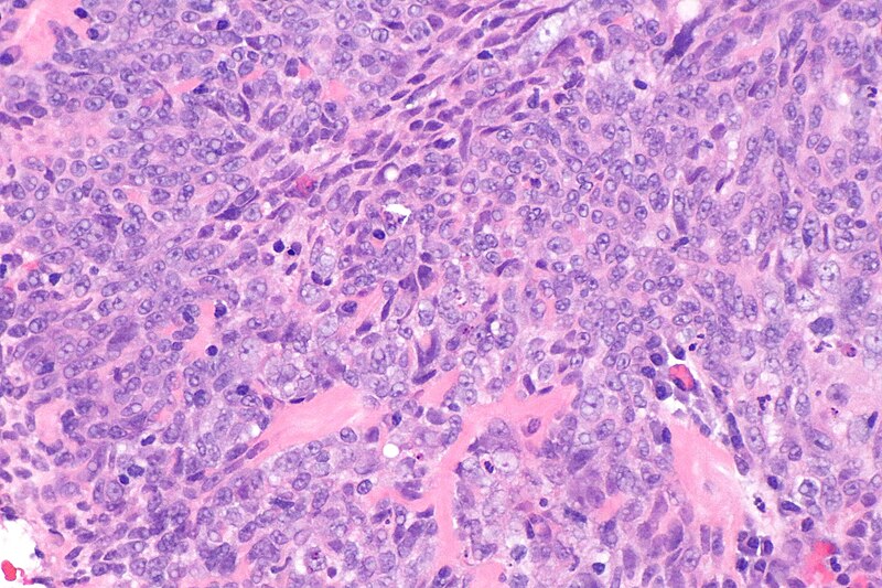 File:Nasopharyngeal carcinoma - alt -- high mag.jpg