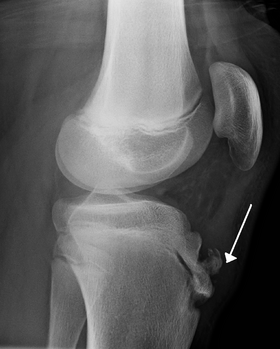 Radiograph of human knee with Osgood–Schlatter disease.png