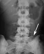 Sacralization of the L5 vertebra is seen at the lower right of the image. Sacralization of the fifth lumbar vertebra.jpg