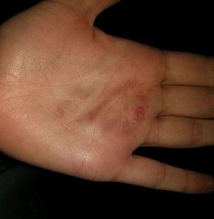 Scarring as a result of the salt and ice challenge, eleven days after performing it