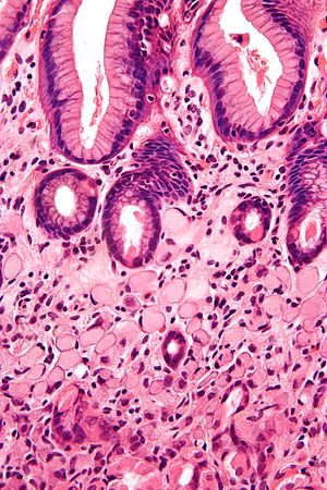 gastric cancer pathology hpv virus and weight gain