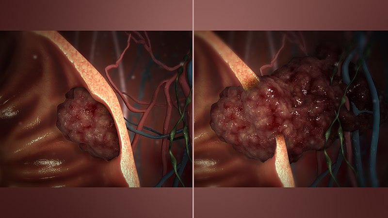 benign tumor vs malignant