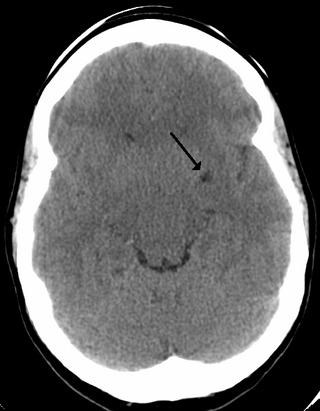 <span class="mw-page-title-main">Perivascular space</span>