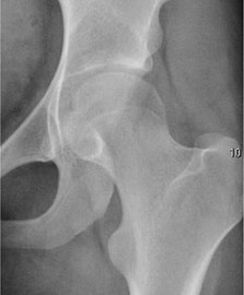 Radiography in normal hip