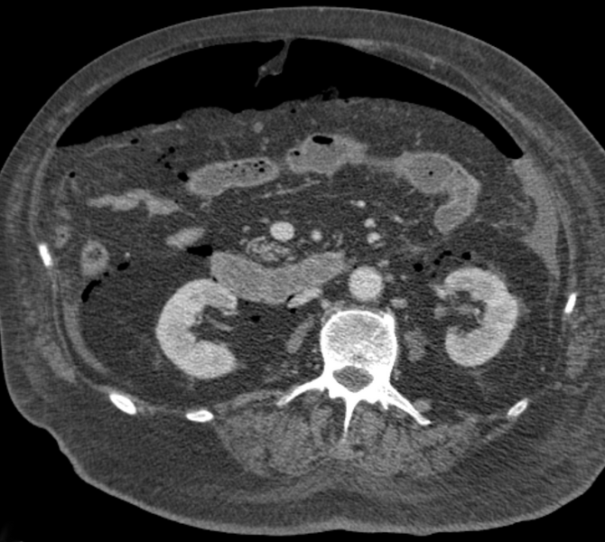 File:20-03-Anastomoseninsuffizienz freie Luft - CT2.png