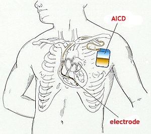 Implantable Cardioverter-Defibrillator